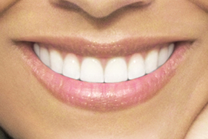 Opalescence Teeth Whitening